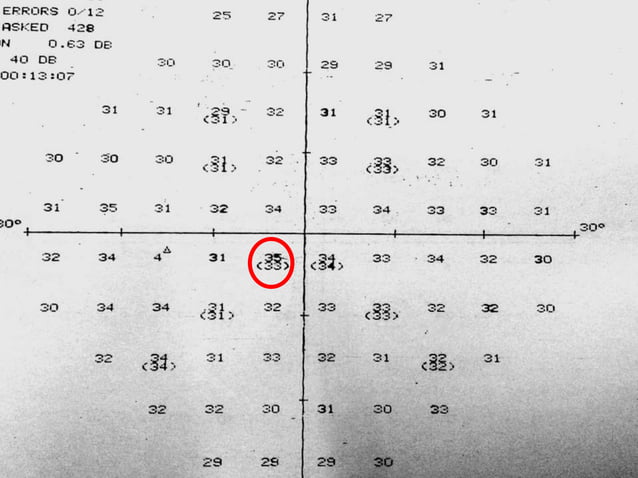 Hfa | PPTX | Eye and Vision Conditions | Diseases and Conditions