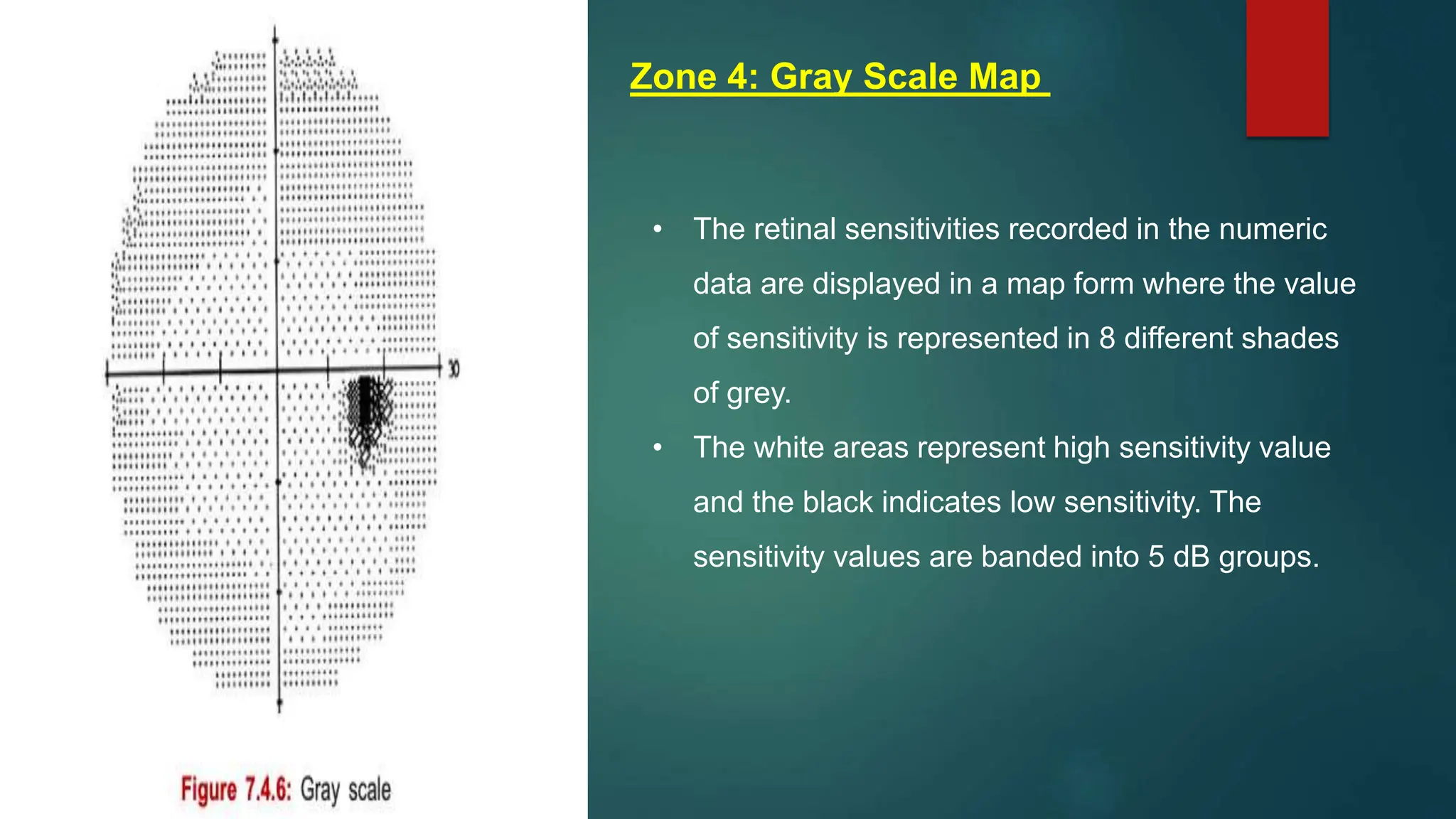 • The retinal sensitivities recorded in the numeric
data are displayed in a map form where the value
of sensitivity is represented in 8 different shades
of grey.
• The white areas represent high sensitivity value
and the black indicates low sensitivity. The
sensitivity values are banded into 5 dB groups.
Zone 4: Gray Scale Map
 