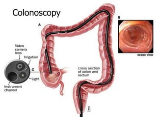 Colorectal Cancer Screening - What does the evidence really say? | PDF