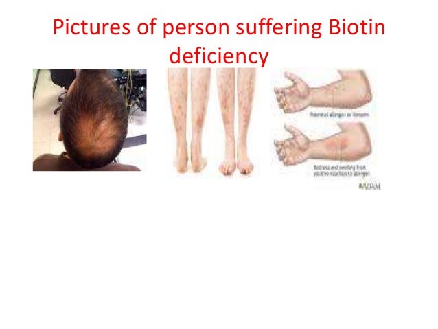 Biotin Deficiency Symptoms In Adults DPHAP Biotin Deficiency Symptoms In Adults DPHAP