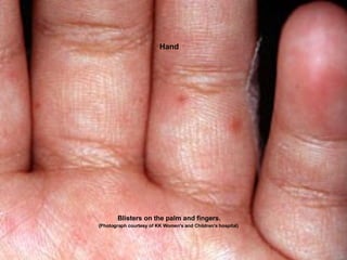 Hand Blisters on the palm and fingers. (Photograph courtesy of KK Women's and Children's hospital)   