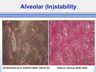 Alveolar (In)stability
JM Steinberg et al. AJRCCM 2004; 169:57-63 DiRocco, Nieman AARC 2005
 