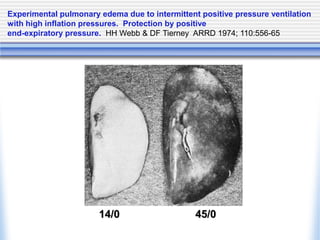 14/0 45/0
Experimental pulmonary edema due to intermittent positive pressure ventilation
with high inflation pressures. Protection by positive
end-expiratory pressure. HH Webb & DF Tierney ARRD 1974; 110:556-65
 