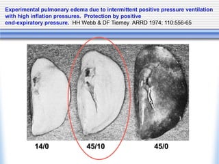 14/0 45/10 45/0
Experimental pulmonary edema due to intermittent positive pressure ventilation
with high inflation pressures. Protection by positive
end-expiratory pressure. HH Webb & DF Tierney ARRD 1974; 110:556-65
 