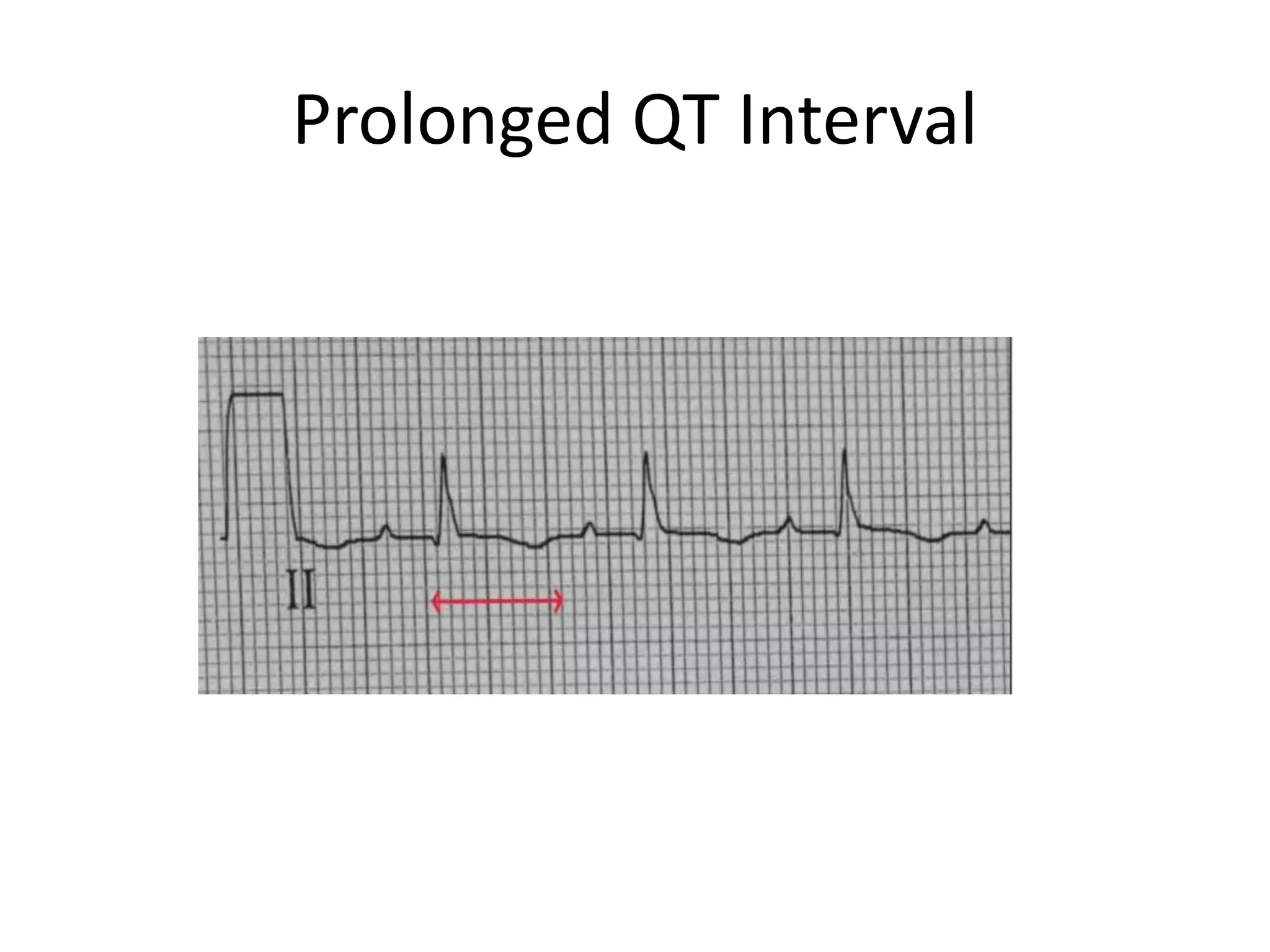 Prolonged QT Interval
 