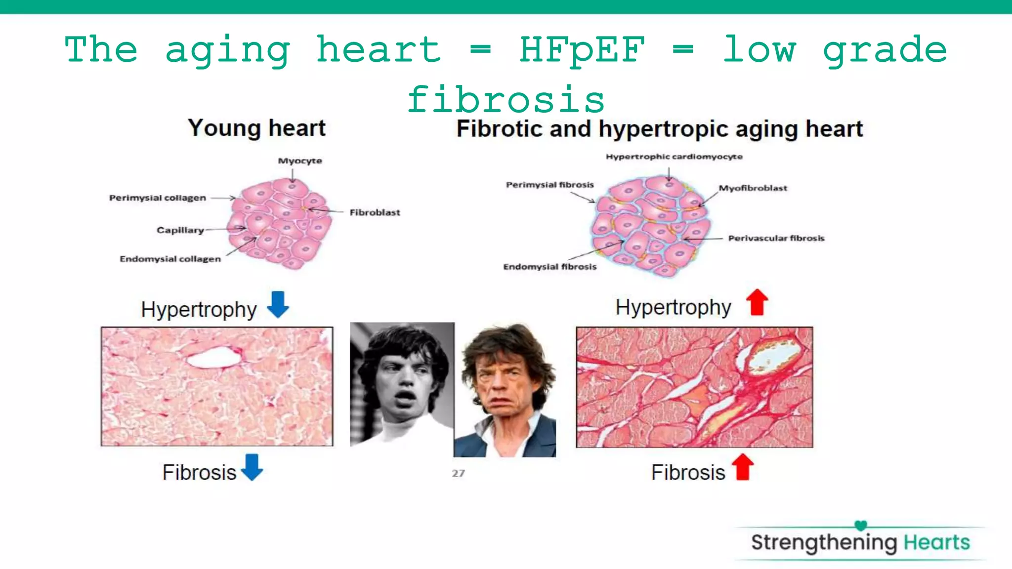 HeART FAILURE Hfpef | PPTX