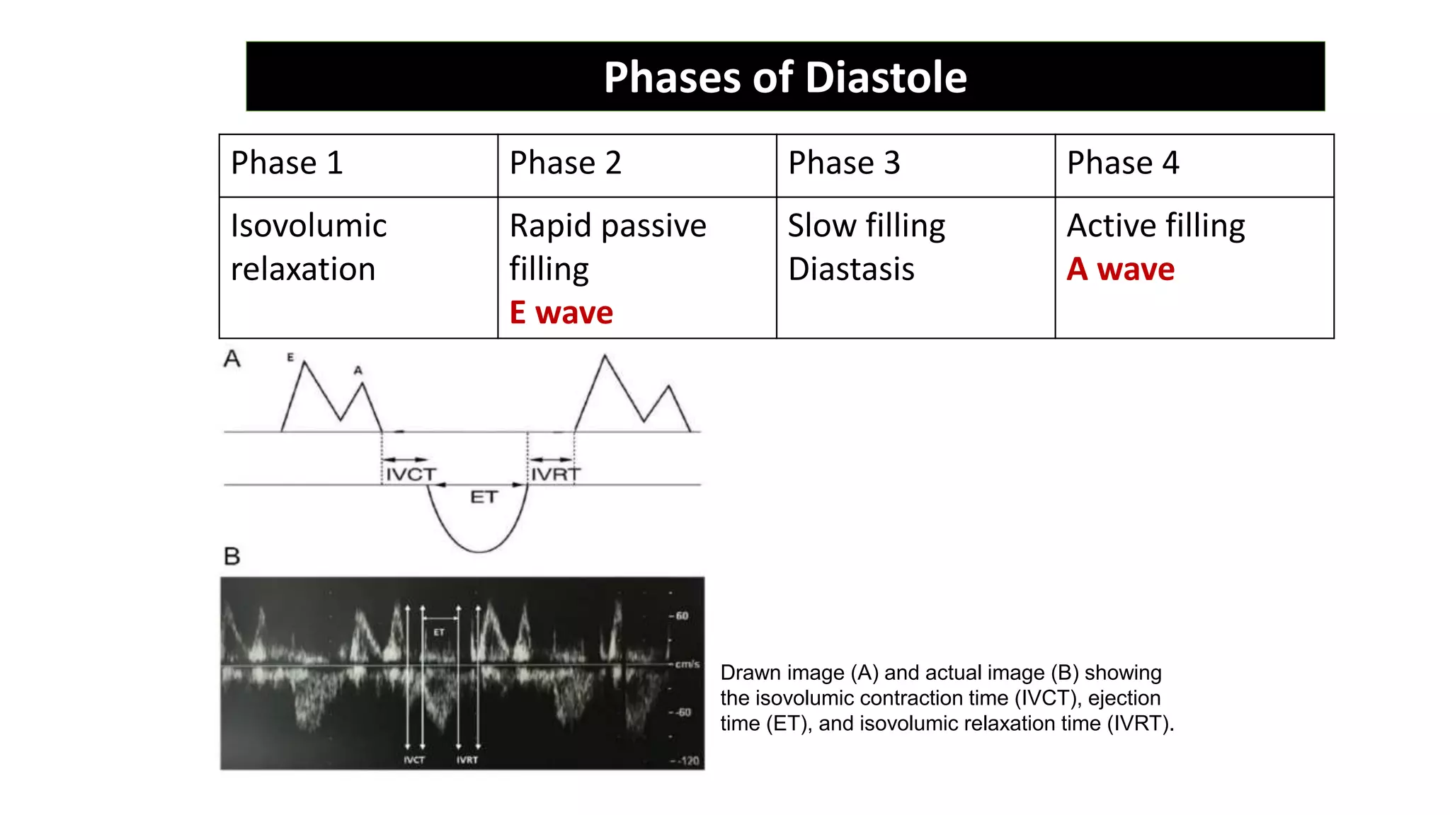 Drawn image (A) and actual image (B) showing
the isovolumic contraction time (IVCT), ejection
time (ET), and isovolumic relaxation time (IVRT).
Phase 1 Phase 2 Phase 3 Phase 4
Isovolumic
relaxation
Rapid passive
filling
E wave
Slow filling
Diastasis
Active filling
A wave
Phases of Diastole
 