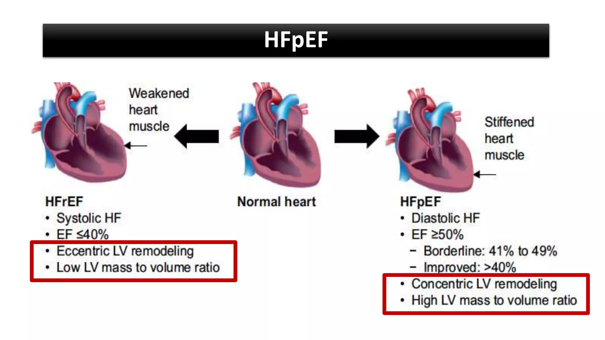 Heart Failure With A Preserved Ejection Fraction Heart Failure with Preserved Ejection Fraction(HFpEF).ptx