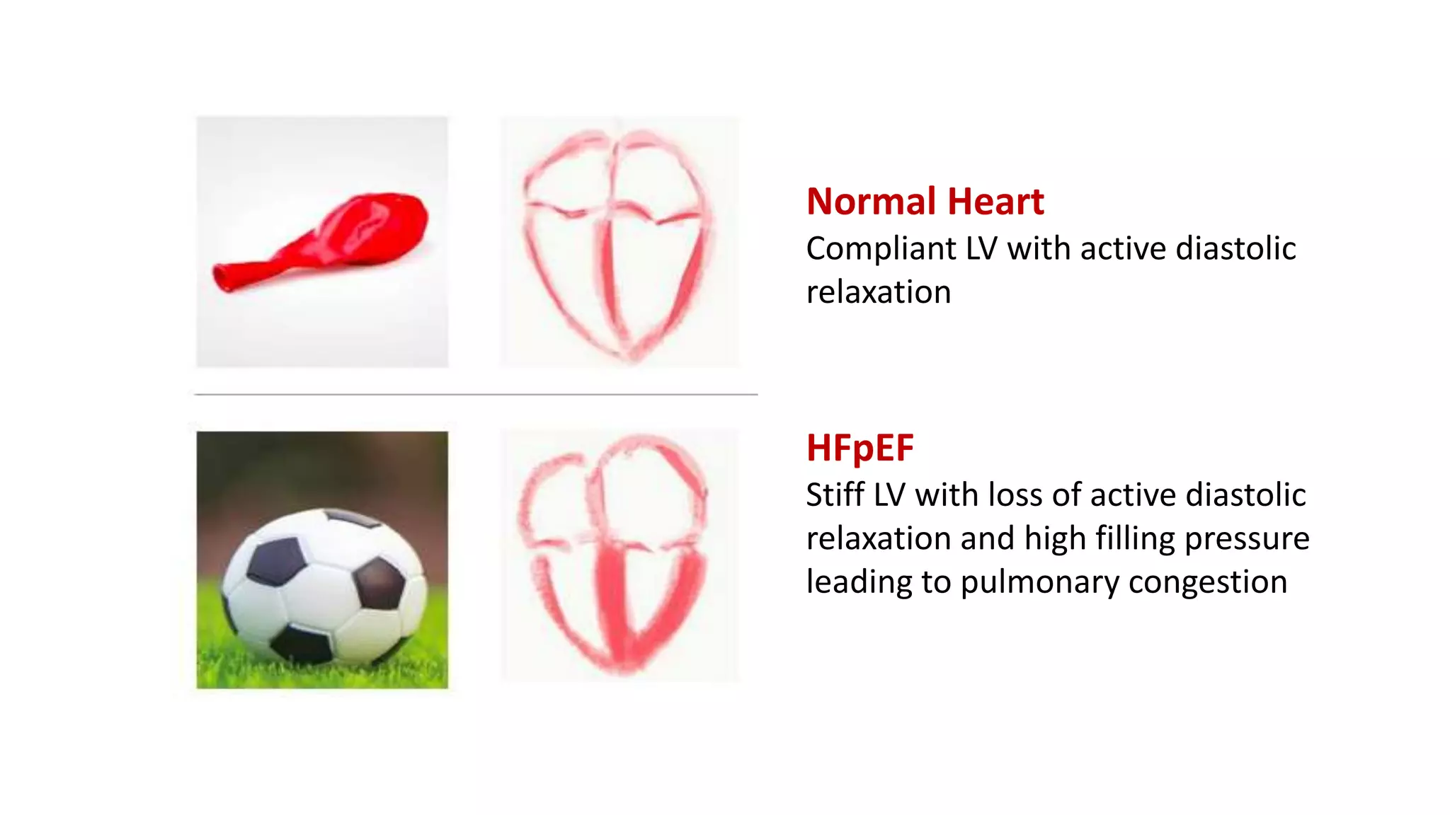 Normal Heart
Compliant LV with active diastolic
relaxation
HFpEF
Stiff LV with loss of active diastolic
relaxation and high filling pressure
leading to pulmonary congestion
 