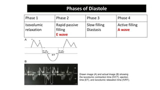 Drawn image (A) and actual image (B) showing
the isovolumic contraction time (IVCT), ejection
time (ET), and isovolumic relaxation time (IVRT).
Phase 1 Phase 2 Phase 3 Phase 4
Isovolumic
relaxation
Rapid passive
filling
E wave
Slow filling
Diastasis
Active filling
A wave
Phases of Diastole
 
