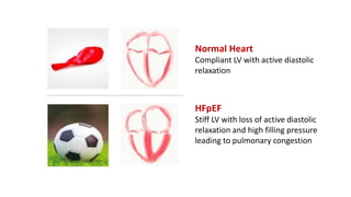 Normal Heart
Compliant LV with active diastolic
relaxation
HFpEF
Stiff LV with loss of active diastolic
relaxation and high filling pressure
leading to pulmonary congestion
 