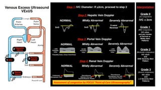 Assessment of congestion by POCUS “Point-of-Care Ultrasonography”
 