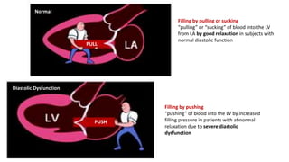 Filling by pulling or sucking
“pulling” or “sucking” of blood into the LV
from LA by good relaxation in subjects with
normal diastolic function
Normal
Diastolic Dysfunction
Filling by pushing
“pushing” of blood into the LV by increased
filling pressure in patients with abnormal
relaxation due to severe diastolic
dysfunction
PULL
PUSH
 