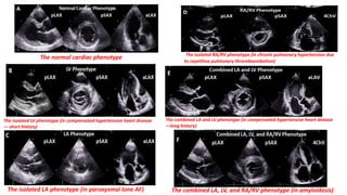 The normal cardiac phenotype
The isolated LV phenotype (in compensated hypertensive heart disease
— short history)
The isolated LA phenotype (in paroxysmal lone AF)
The isolated RA/RV phenotype (in chronic pulmonary hypertension due
to repetitive pulmonary thromboembolism)
The combined LA and LV phenotype (in compensated hypertensive heart disease
—long history)
The combined LA, LV, and RA/RV phenotype (in amyloidosis)
 