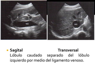  Sagital Transversal
Lóbulo caudado separado del lóbulo
izquierdo por medio del ligamento venoso.
 