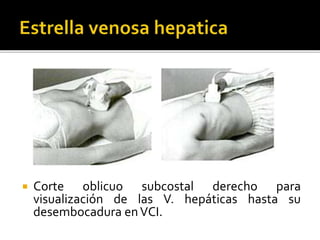  Corte oblicuo subcostal derecho para
visualización de las V. hepáticas hasta su
desembocadura enVCI.
 