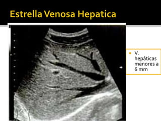  V.
hepáticas
menores a
6 mm
 