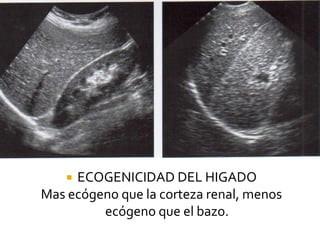  ECOGENICIDAD DEL HIGADO
Mas ecógeno que la corteza renal, menos
ecógeno que el bazo.
 
