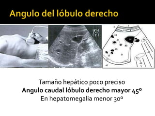 Tamaño hepático poco preciso
Angulo caudal lóbulo derecho mayor 45º
En hepatomegalia menor 30º
 