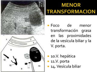  Foco de menor
transformación grasa
en las proximidades
de la vesícula biliar y la
V. porta.
 10.V. hepática
 11.V. porta
 14.Vesícula biliar
 