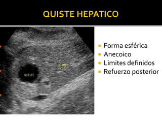  Forma esférica
 Anecoico
 Limites definidos
 Refuerzo posterior
 