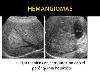  Hiperecoicos en comparación con el
parénquima hepático.
 