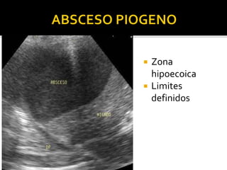  Zona
hipoecoica
 Limites
definidos
 