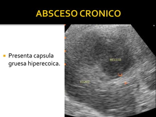  Presenta capsula
gruesa hiperecoica.
 