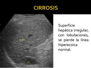 Superficie
hepática irregular,
con lobulaciones,
se pierde la línea
hiperecoica
normal.
 