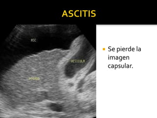  Se pierde la
imagen
capsular.
 