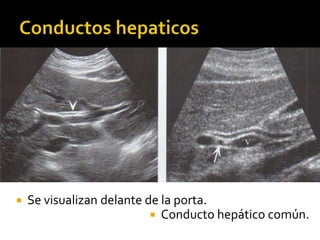 Se visualizan delante de la porta.
 Conducto hepático común.
 