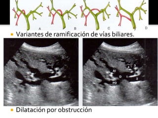  Variantes de ramificación de vías biliares.
 Dilatación por obstrucción
 