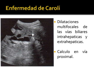  Dilataciones
multifocales de
las vías biliares
intrahepaticas y
extrahepaticas.
 Calculo en vía
proximal.
 