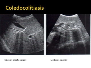 Cálculos intrahepaticos Múltiples cálculos
 