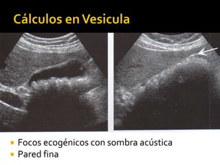  Focos ecogénicos con sombra acústica
 Pared fina
 