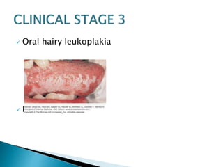  Oral hairy leukoplakia 
 Pulmonary TB 
 