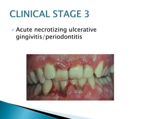  Acute necrotizing ulcerative 
gingivitis/periodontitis 
 