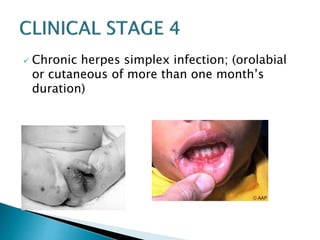  Chronic herpes simplex infection; (orolabial 
or cutaneous of more than one month’s 
duration) 
 
