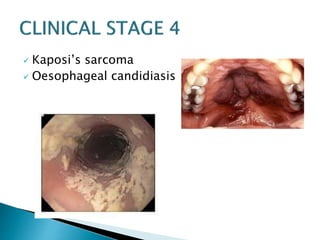  Kaposi’s sarcoma 
 Oesophageal candidiasis 
 