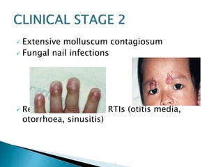  Extensive molluscum contagiosum 
 Fungal nail infections 
 Recurrent or chronic RTIs (otitis media, 
otorrhoea, sinusitis) 
 