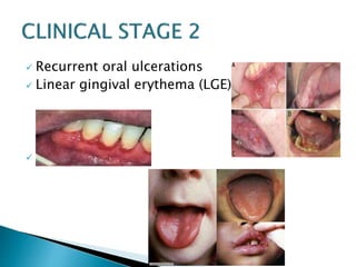 Recurrent oral ulcerations 
 Linear gingival erythema (LGE) 
 Angular cheilitis 
 