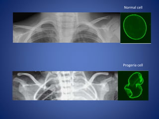 Normal cell
Progeria cell
 