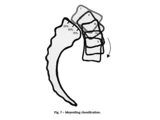 HighGradeSpondylolisthesis.pptx