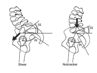 HighGradeSpondylolisthesis.pptx