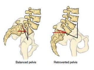 HighGradeSpondylolisthesis.pptx