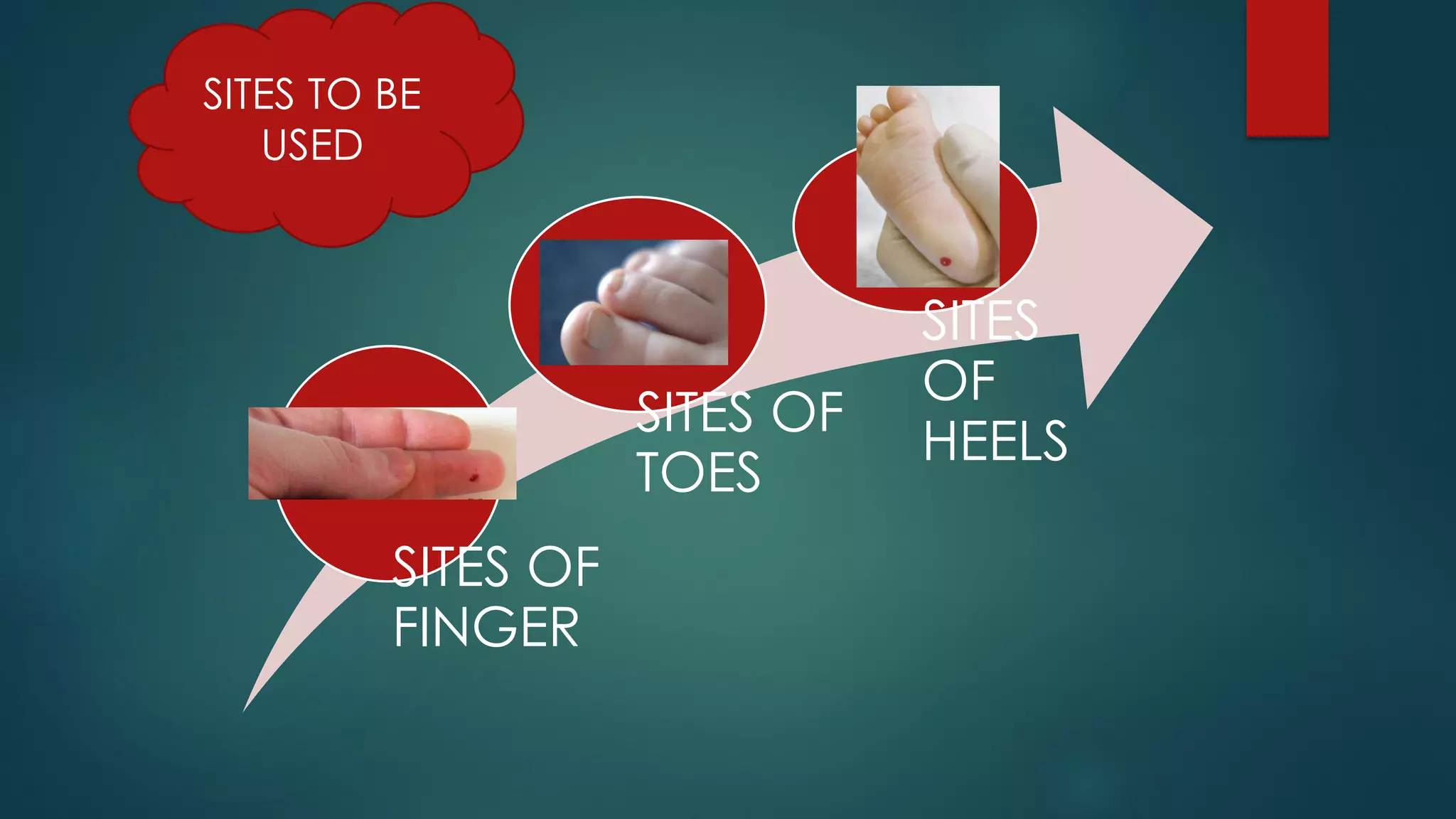 SITES OF
FINGER
SITES OF
TOES
SITES
OF
HEELS
SITES TO BE
USED
 