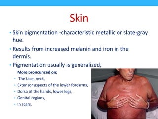 Skin
• Skin pigmentation -characteristic metallic or slate-gray
hue.
• Results from increased melanin and iron in the
dermis.
• Pigmentation usually is generalized,
More pronounced on;
• The face, neck,
• Extensor aspects of the lower forearms,
• Dorsa of the hands, lower legs,
• Genital regions,
• In scars.
 