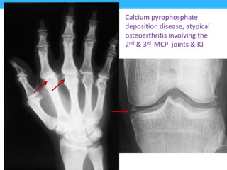 Calcium pyrophosphate
deposition disease, atypical
osteoarthritis involving the
2nd & 3rd MCP joints & KJ
 