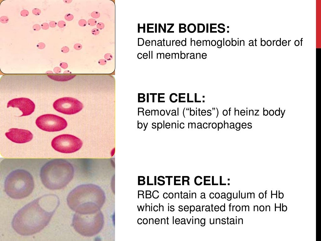 Hereditary Hemolytic Anemias