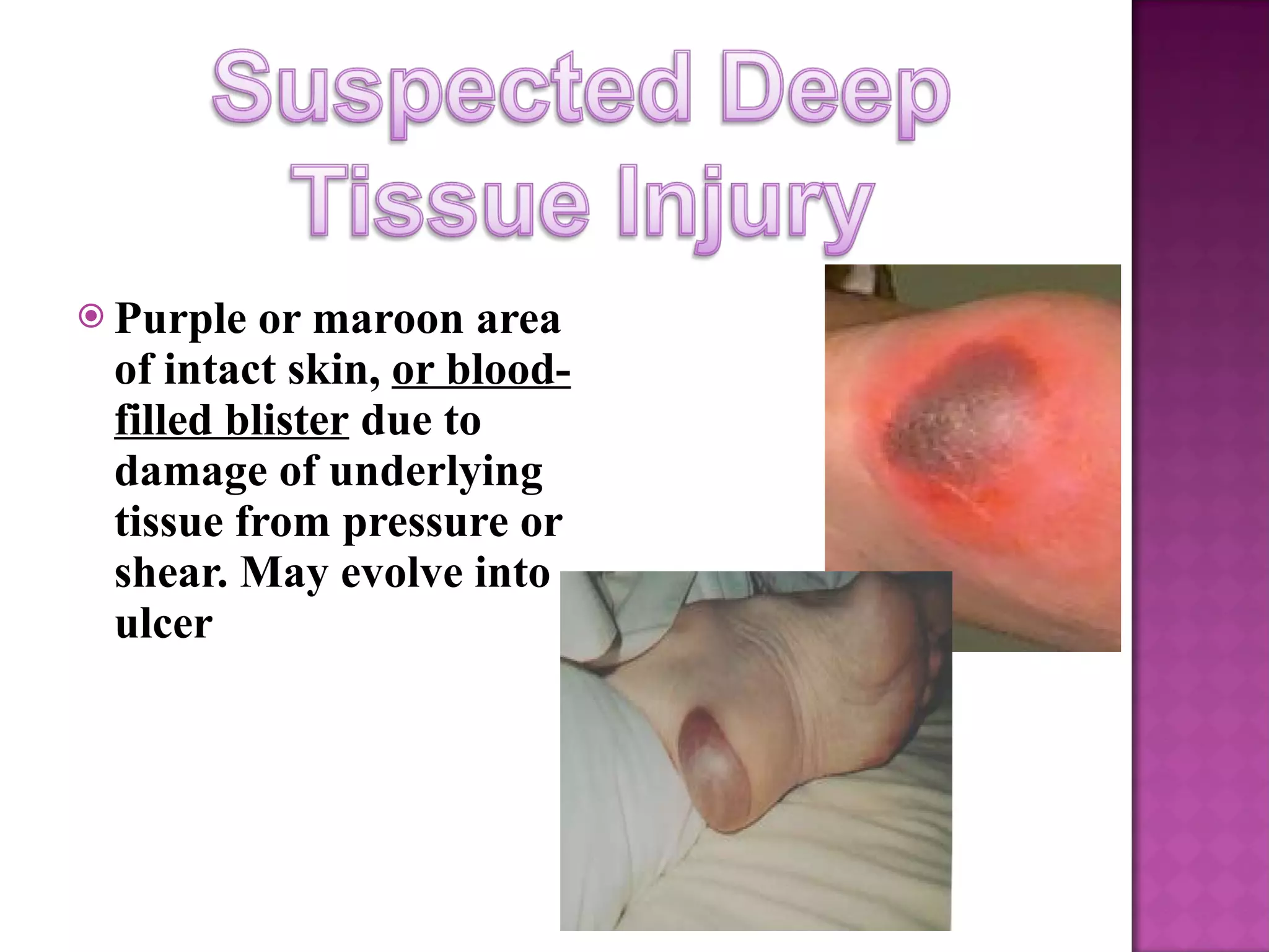 WOUND CARE | PPT